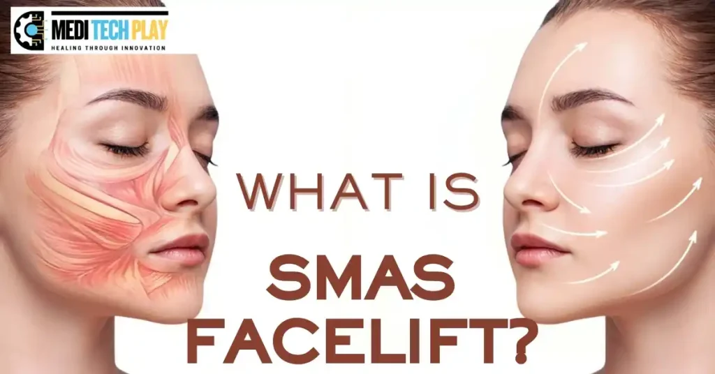 smas facelift