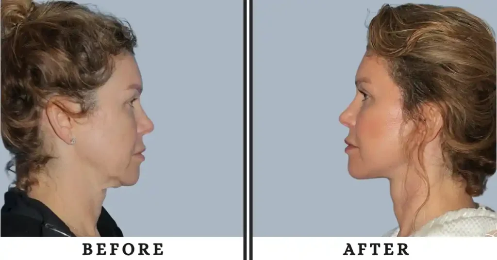 smas facelift