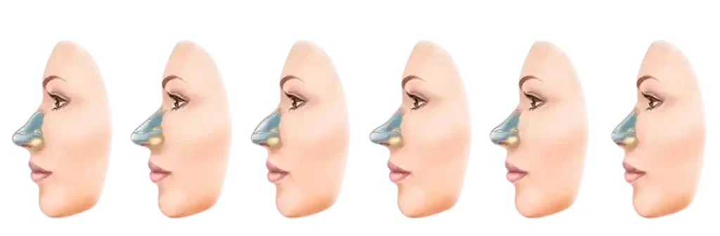 nose surgery in chicago