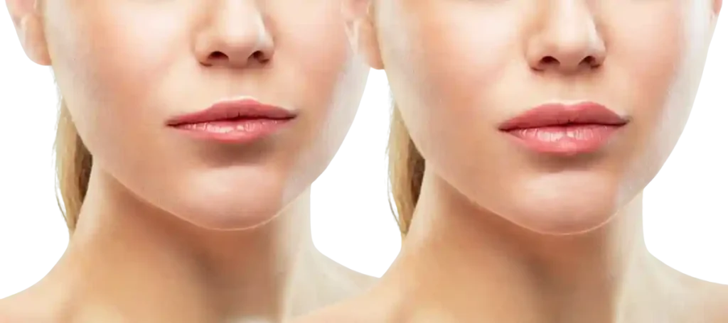 dermal fillers near me
