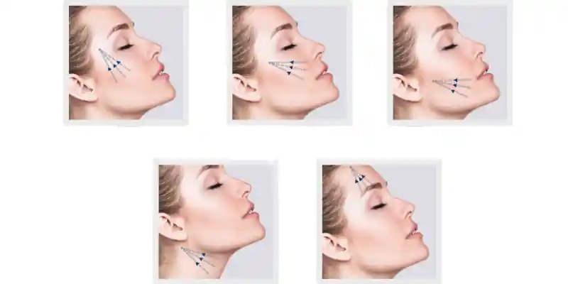jawline filler near me