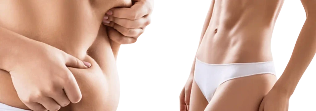 tubeless tummy tuck nyc