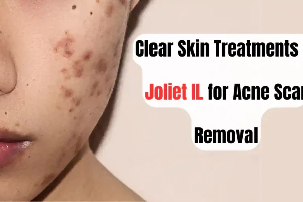 acne scar removal near me