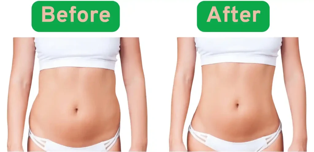 tummy tuck before and after