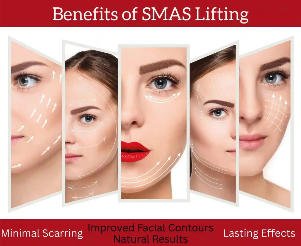 smas lifting