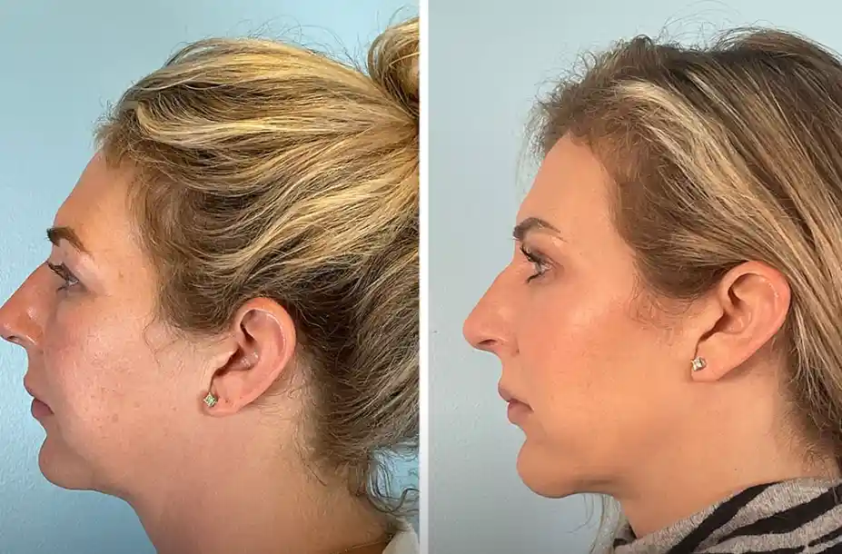 jawline filler near me