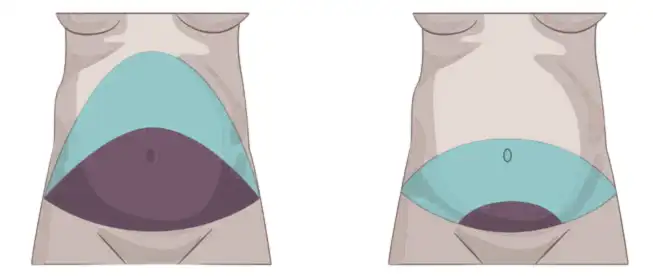 best tubeless tummy tuck in nyc