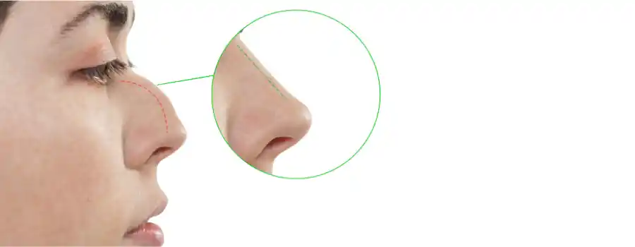 nose surgery in chicgo