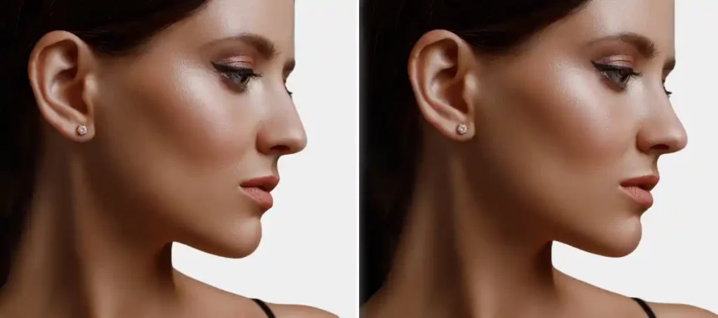best nose job surgeon in chicago