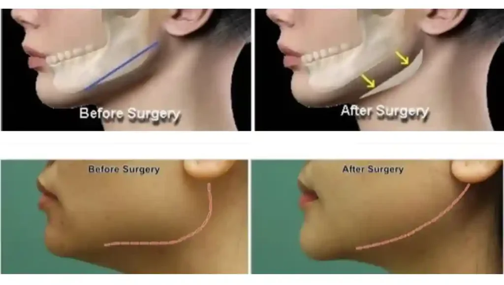 jawline contouring chicago