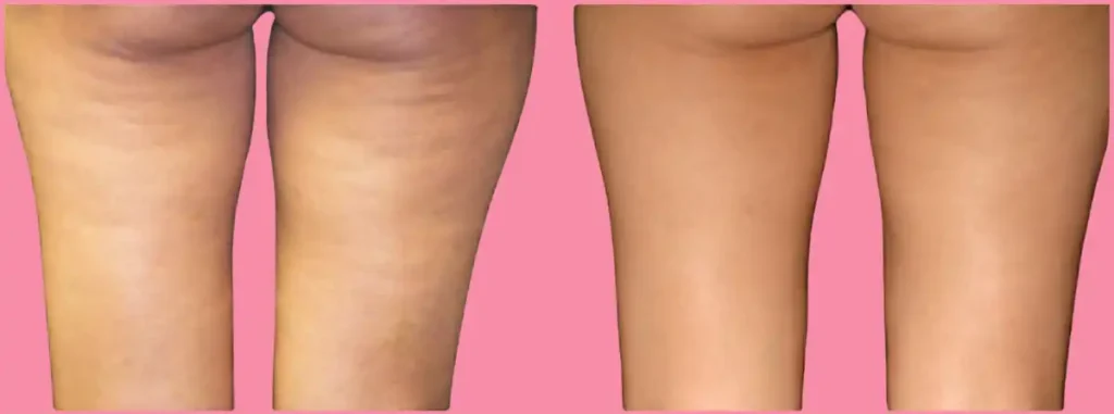 cellulite injections nyc