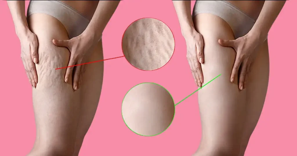 cellulite injections nyc