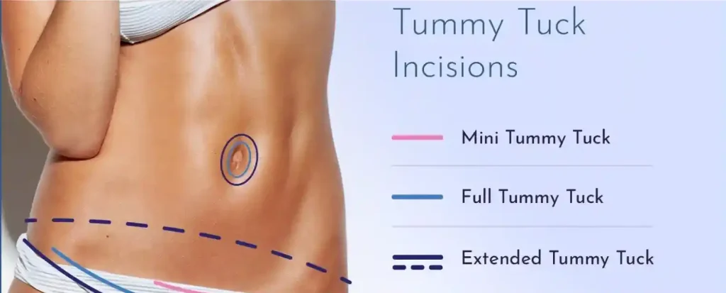 tubeless tummy tuck nyc