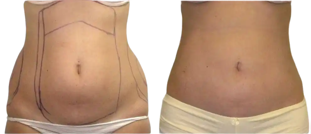 best tubeless tummy tuck in nyc