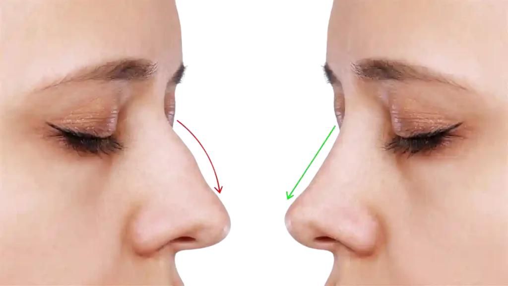 nose surgery in chicago
