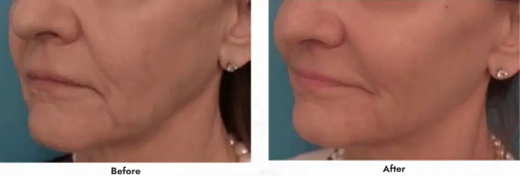 j-plasma before and after