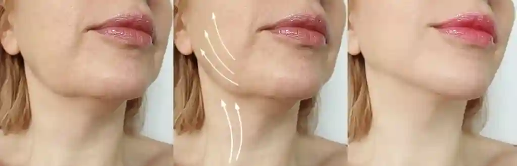 jawline filler near me