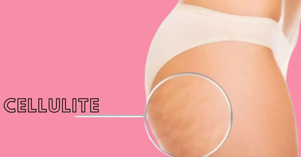 cellulite injections nyc
