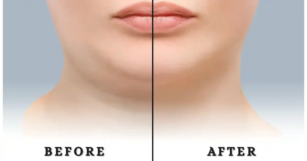 neck liposuction nyc