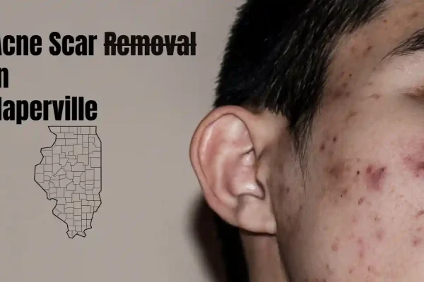 Acne Scar Removal Near Me for Clear Skin in Naperville acne scar removal near me