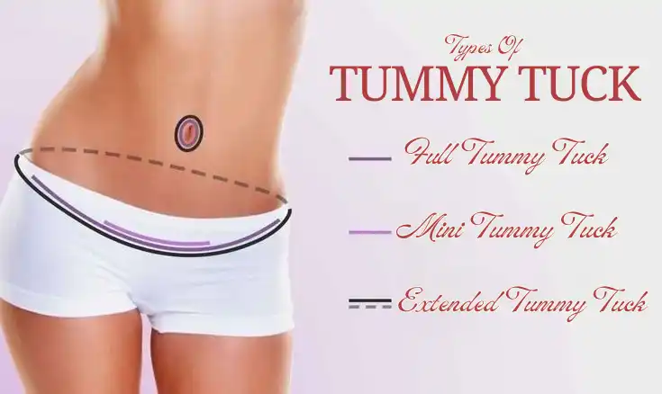 tummy tuck chicago