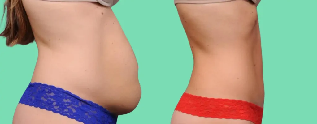 tummy tuck before and after