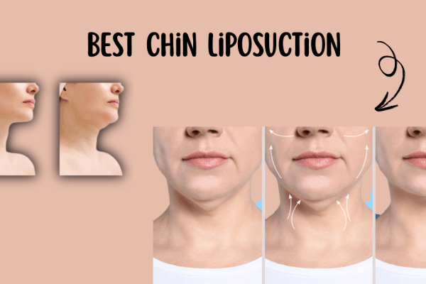 Best Chin Liposuction in Chicago for Jawline Contour Best Chin Liposuction in Chicago for Jawline Contour