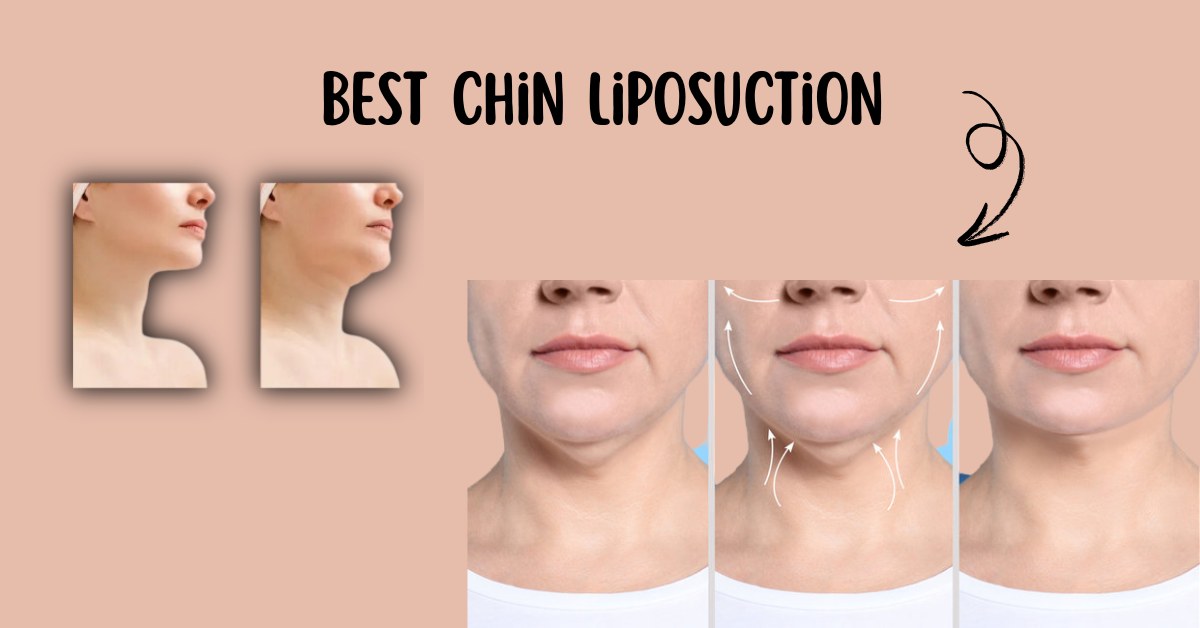 Best Chin Liposuction in Chicago for Jawline Contour