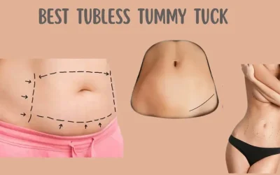 Best Tubeless Tummy Tuck in New York