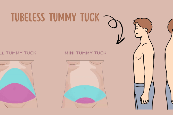 Tubeless Tummy Tuck in NYC: Revolutionizing Abdominal Contouring