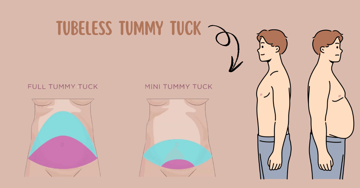 Tubeless Tummy Tuck in NYC: Revolutionizing Abdominal Contouring
