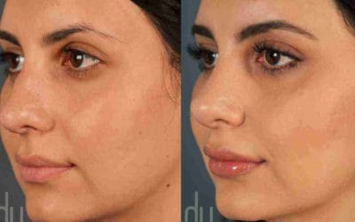 nose job clinic