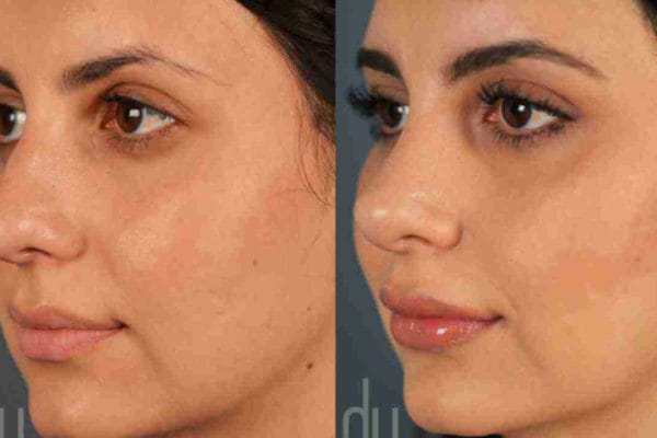 nose job clinic