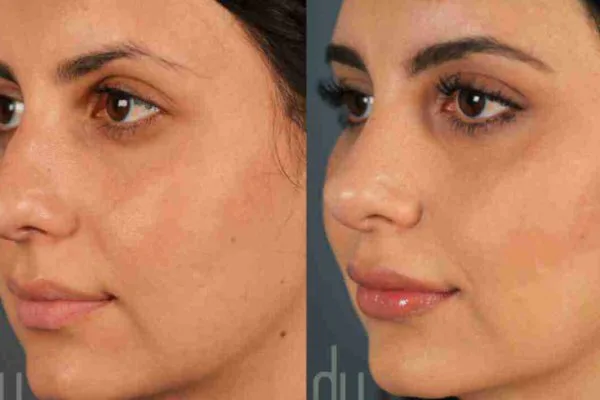 nose job clinic
